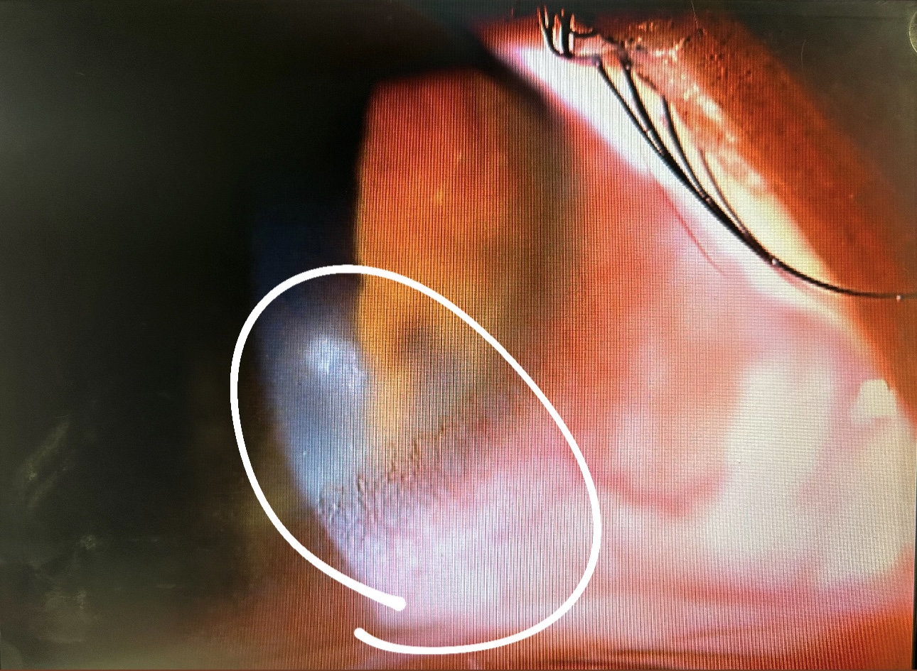 角膜潰瘍
Corneal ulcer