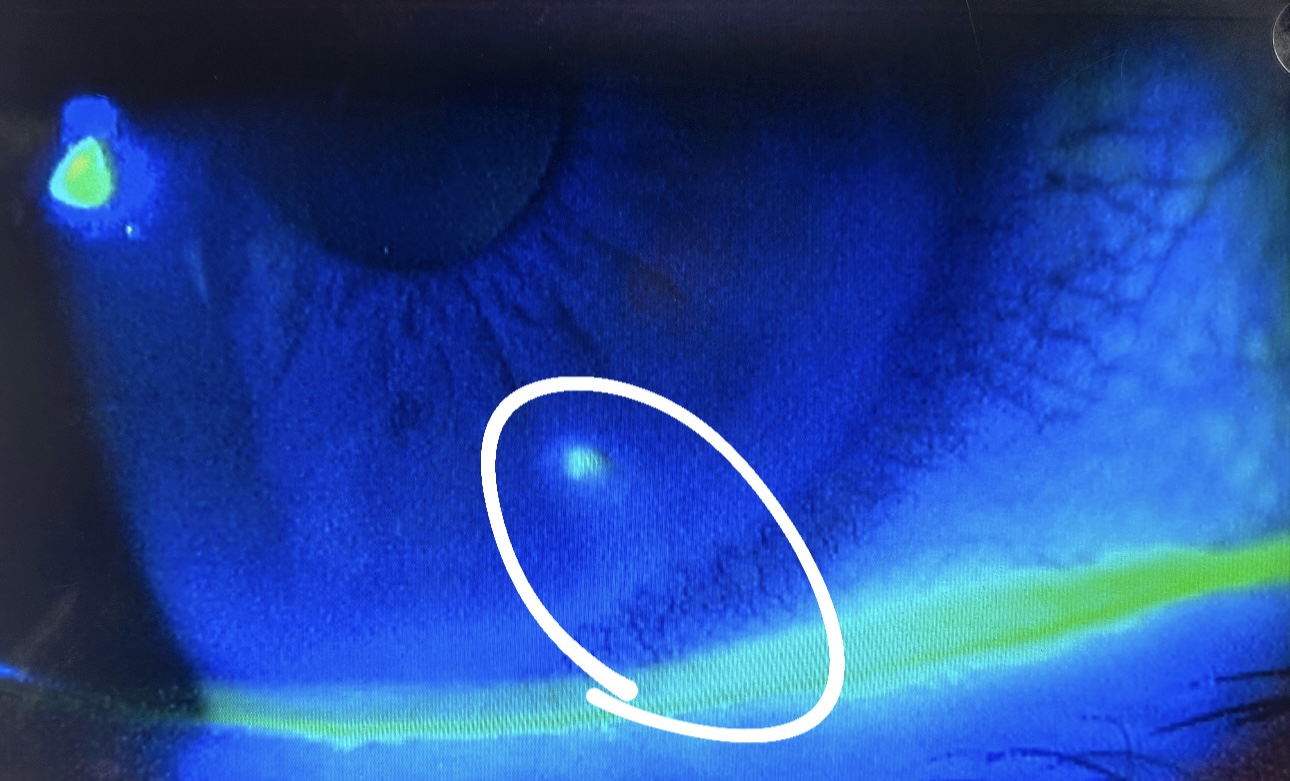 角膜潰瘍
Corneal ulcer