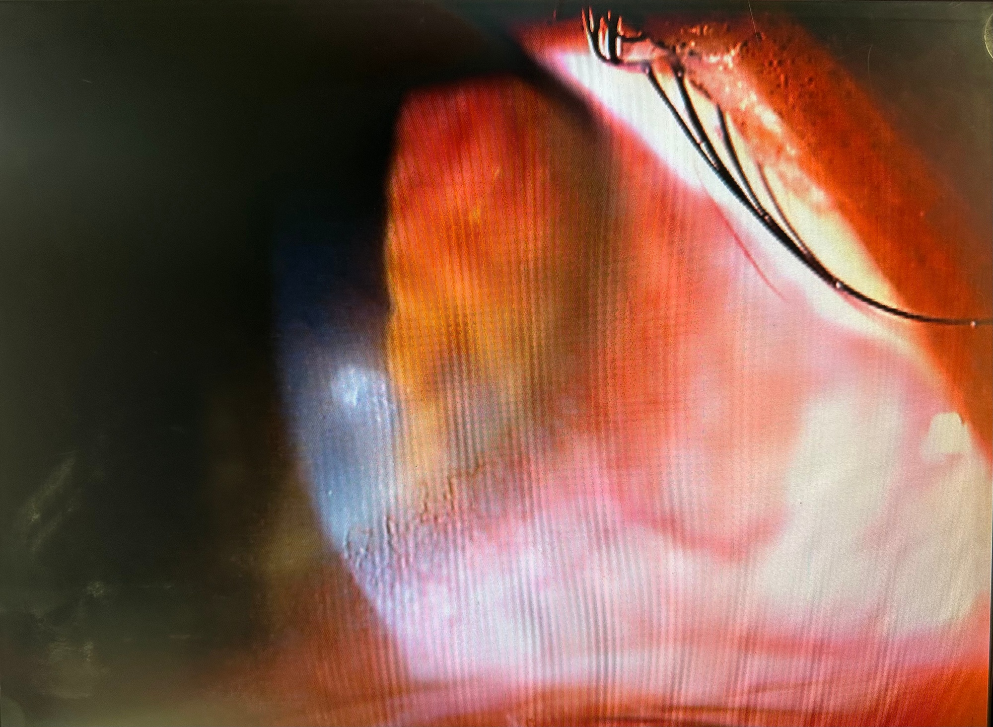 角膜潰瘍
Corneal ulcer